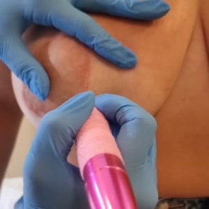 Corso Areola mammaria